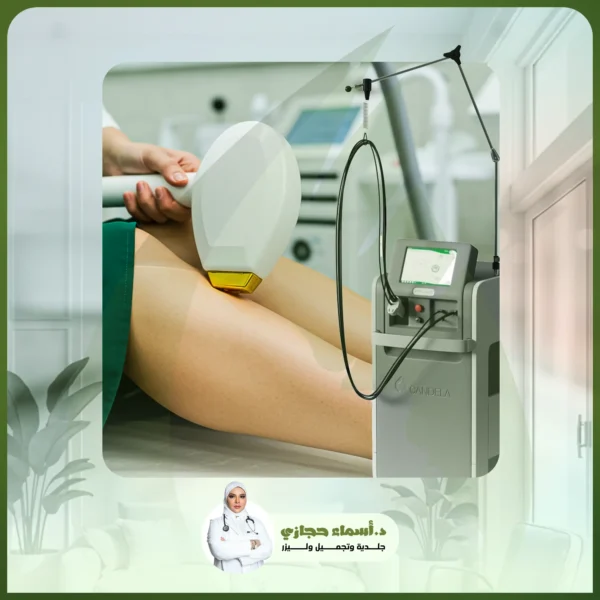 إزالة الشعر الساقين بالليزر