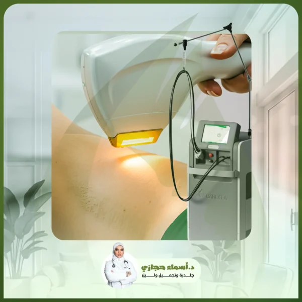 ازالة شعر الابط بالليزر