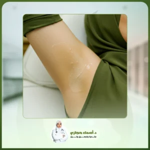 التقشير البارد للابط