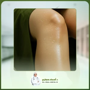 التقشير البارد للركب