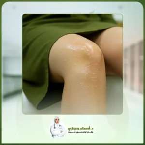 التقشير الكيميائي للركب