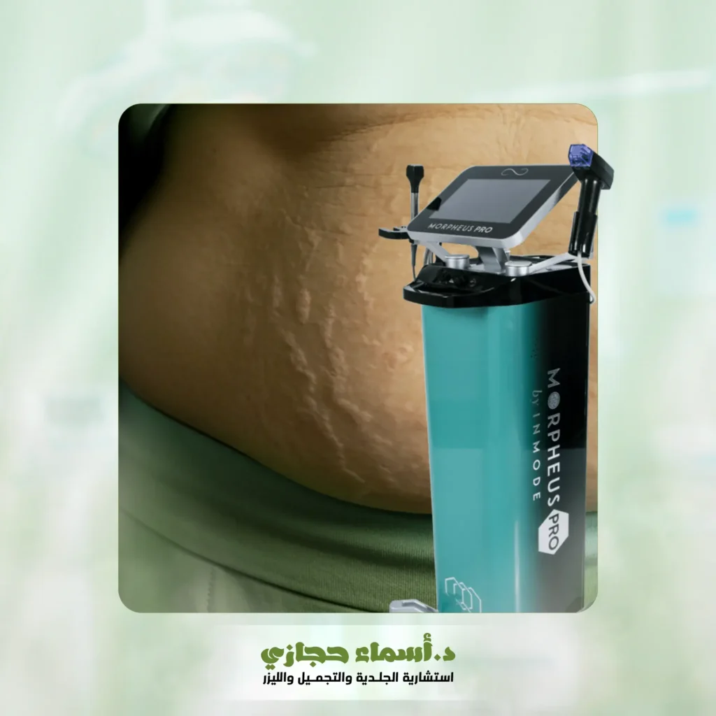 جهاز المورفيس