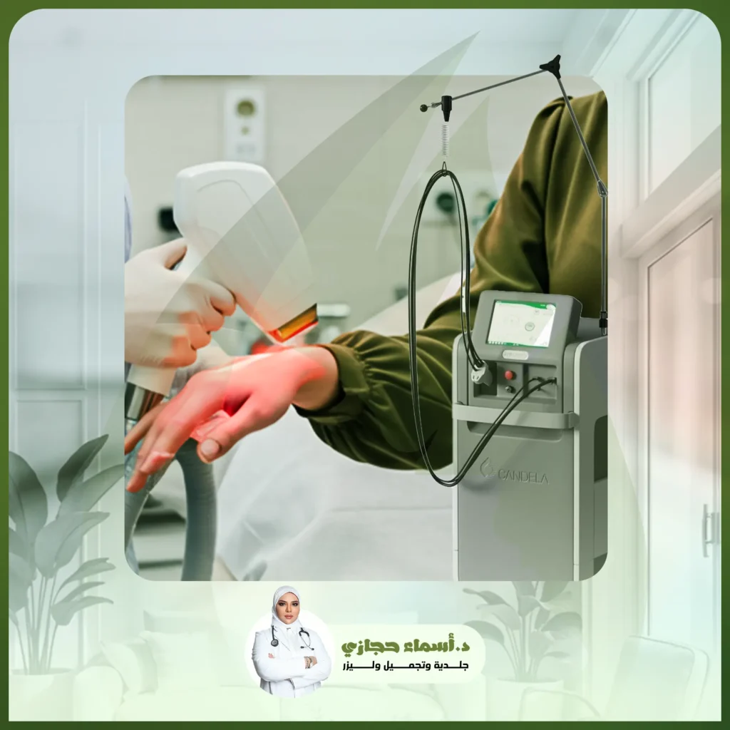 إزالة الشعر بالليزر