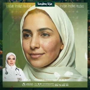 عروض ازالة النمش بالليزر في جدة
