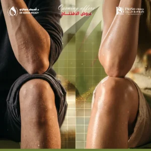 عروض التقشير الكيميائي للجسم في جدة