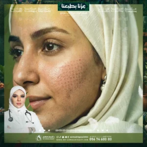 عروض الفراكشنال ليزر للمسامات في جدة