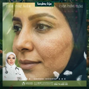 عروض الفراكشنال ليززر للوجه في جدة