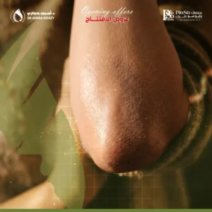 عروض الميزوثيرابي الأكواع في جدة
