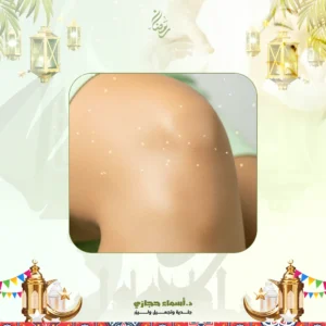 عروض الميزوثيرابي الركب في جدة