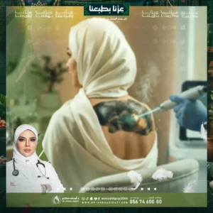 عروض تشقير الظهر بالليزر في جدة