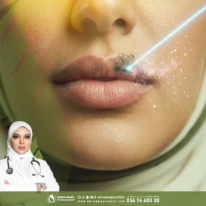 عروض توريد الشفايف بالبيكو ليزر في جدة