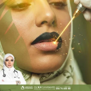 عروض توريد الشفايف بالليزر الكربوني
