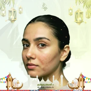 عروض جهاز الفراكشنال لاثار حب الشباب في جدة