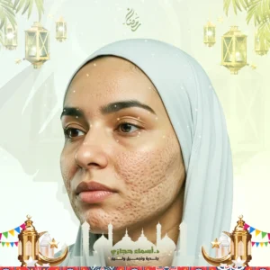 عروض ليزر الفراكشنال للندبات في جدة