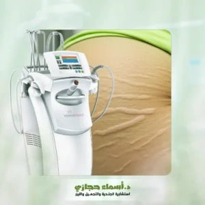 علاج السيلوليت