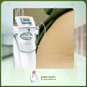 علاج السيلوليت
