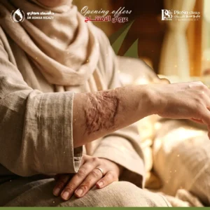 عروض إزالة آثار الحروق مع د.أسماء حجازي في جدة