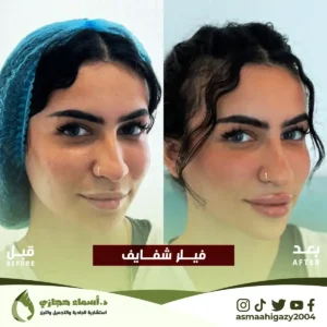 فيلر الشفايف ستايلج