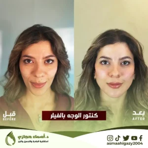 ابرة فيلر