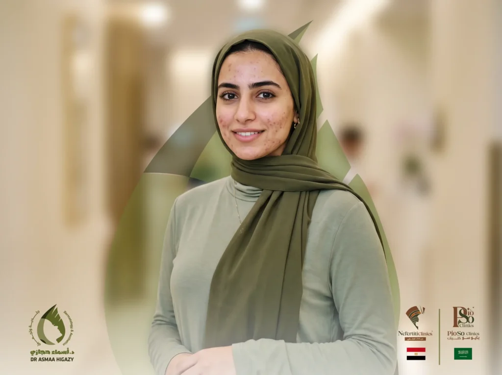التقشير العلاجي لعلاج حب الشباب